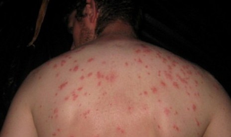 Skin rashes